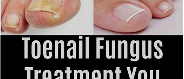 Cvs nail fungus treatment